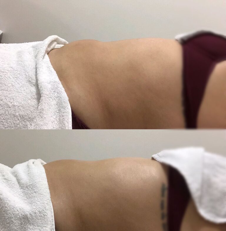 Antes e depois · Estela Maris — centro estético e salão de beleza em Centro, Cerquilho - SP