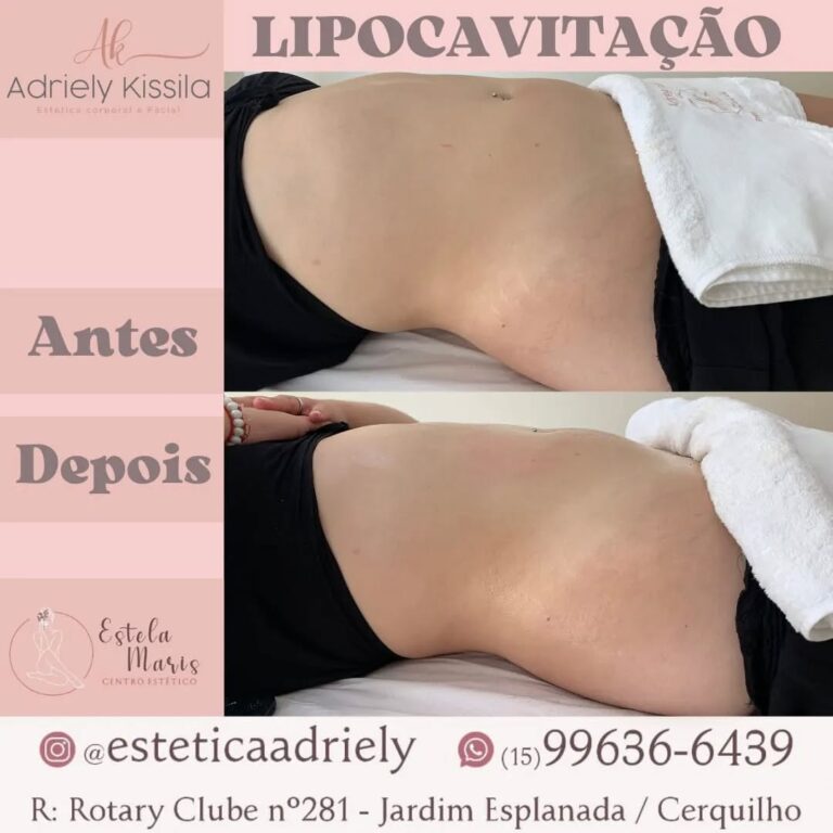 Antes e depois · Estela Maris — centro estético e salão de beleza em Centro, Cerquilho - SP